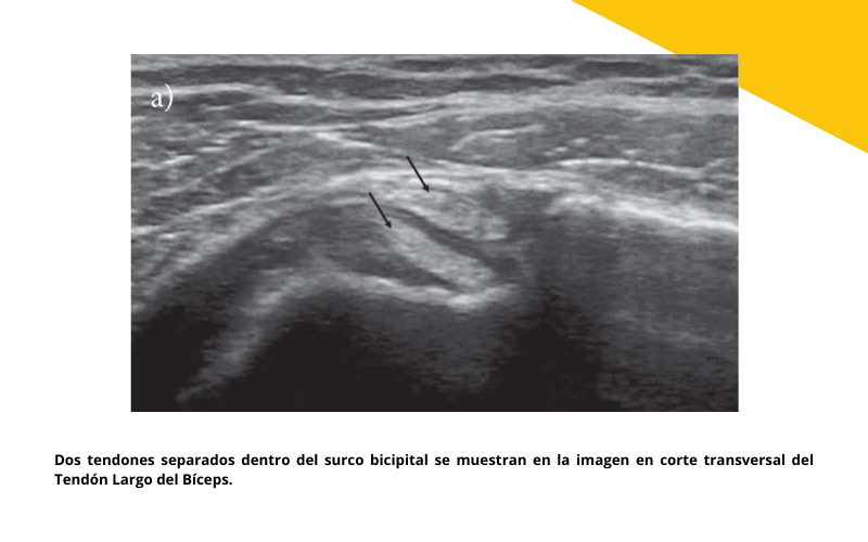 1. Ecografia Tendon largo biceps tempo formacion.png